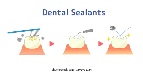 illustrations of dental sealants treatment before after