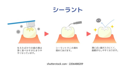 illustrations of dental sealants treatment before after 
[Translation:Dental sealant method]