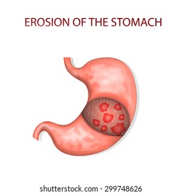 illustrations of the erosion of the stomach