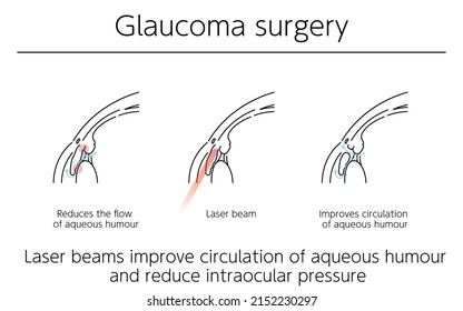 Illustrations, Glaucoma surgery, Medical Illustrations.