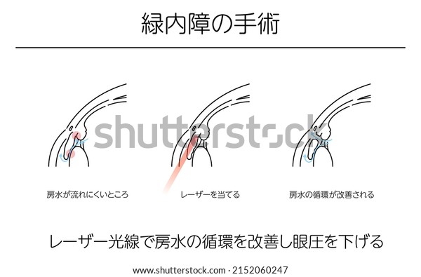 Illustrations, Glaucoma surgery, Medical\
Illustrations. - Translation: glaucoma surgery, laser light\
improves circulation of aqueous humour and lowers intraocular\
pressure, where aqueous humour is\
dif