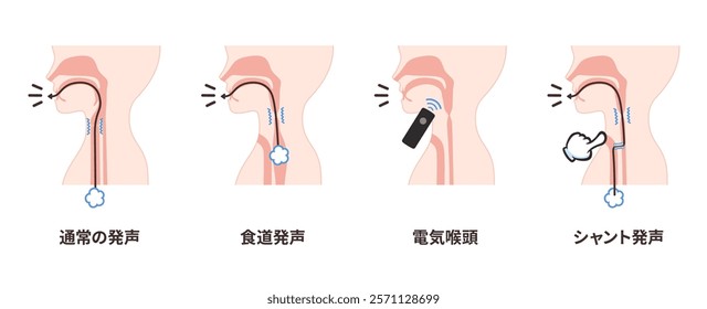 Illustrations of how to speak after laryngeal cancer surgery_Translation: normal speech, esophageal speech, electrolarynx, shunt speech