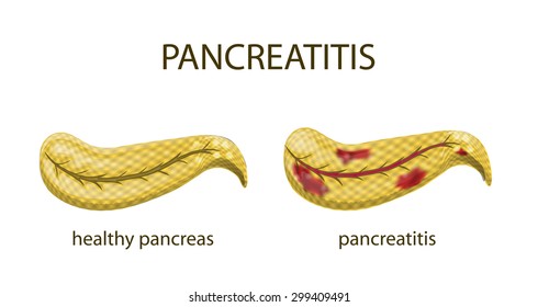 illustrations of the pancreas healthy and pancreatitis