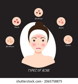 Illustrations Types of acne occur on a Woman Face
