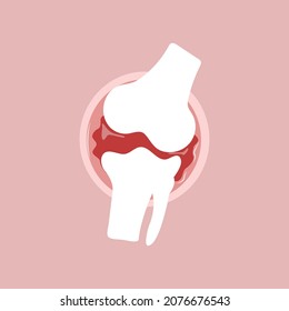 Illustrative flat vector of arthritis