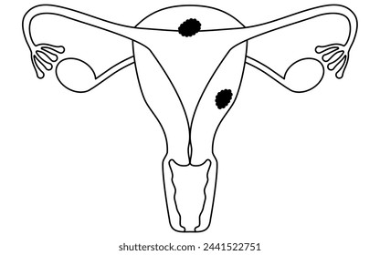 Illustrative illustrations of Endometrial cancer, anatomy of the uterus and ovaries, Vector Illustration