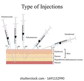 Different Types Of Injections - Goimages Today