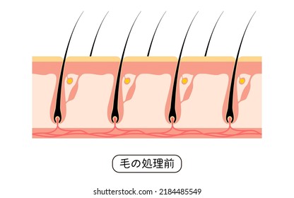 Image of hair removal, before and untreated hair - Translation: before hair treatment