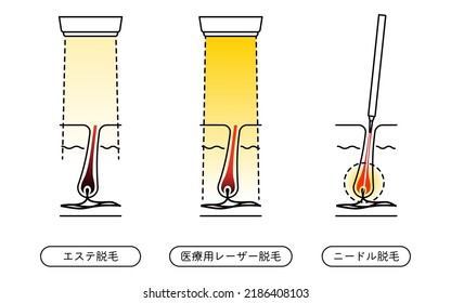 Image of Hair Removal, Esthetic depilation, Medical Laser Hair Removal, Needle Hair Removal - Translation: Esthetic depilation, Medical Laser epilation, Needle Hair Removal