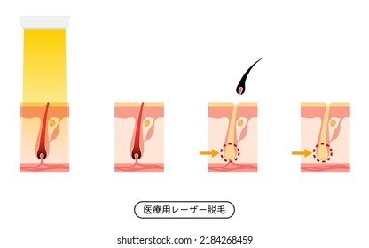 Image of hair removal, the process of hair removal after medical laser hair removal treatment - Translation: Medical Laser Hair Removal