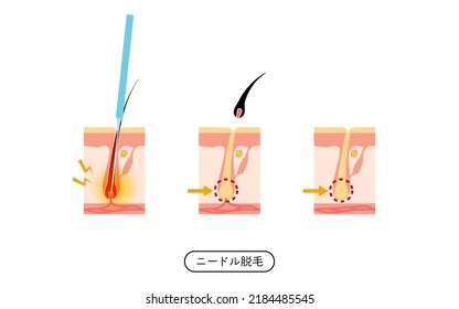 Image of hair removal, the process of hair removal after needle hair removal treatment - Translation: Needle Hair Removal