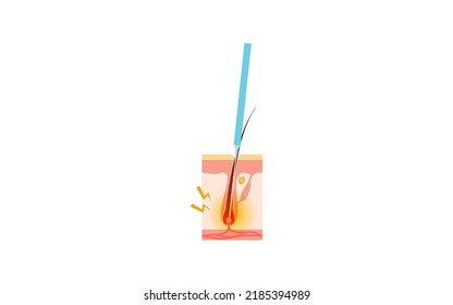 Image of hair removal, the process of hair removal after needle hair removal treatment
