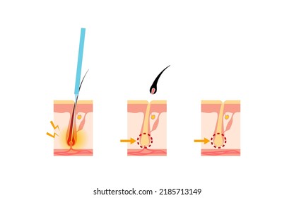 Image of hair removal, the process of hair removal after needle hair removal treatment