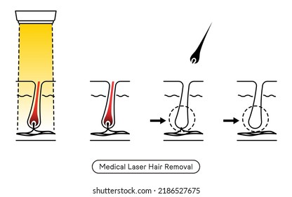 Image of hair removal, the process of hair removal after medical laser hair removal treatment