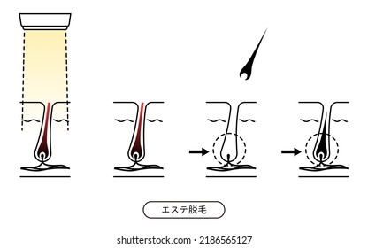 Bild der Haarentfernung, Haarentfernung nach ästhetischer Haarentfernung - Übersetzung: Ästhetische Depilation