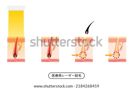 Image of hair removal, the process of hair removal after medical laser hair removal treatment - Translation: Medical Laser Hair Removal