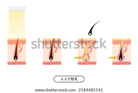 Image of hair removal, the process of hair removal after esthetic hair removal treatment - Translation: Esthetic Hair Removal
