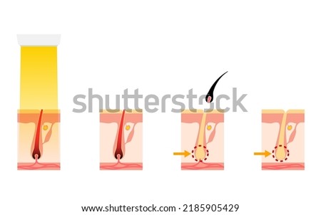 Image of hair removal, the process of hair removal after medical laser hair removal treatment