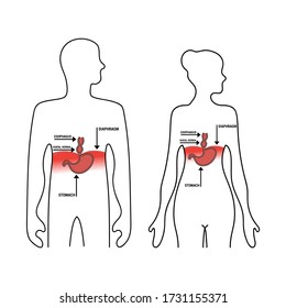 Image of a hiatus hernia. Descriptive icon of disease.