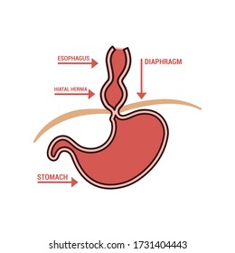 Image of a hiatus hernia. Descriptive icon of disease.