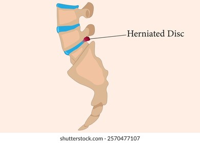 The image illustrates a herniated disc in the human spine with labeled detail. eps 10