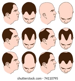 An image of man with various receding hairlines.
