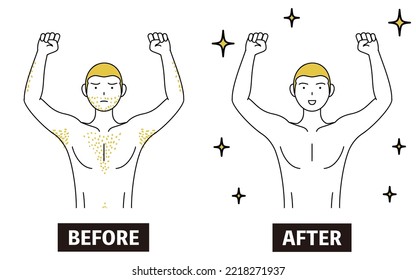 Image of medical hair removal, before-and-after of a man suffering from thick body hair being removed and becoming smooth.