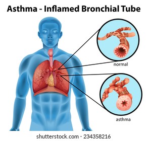 An image showing the asthma-inflamed bronchial tube on a white background 