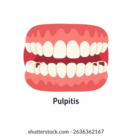 The image shows teeth with visible cavities and decay, pulpitis