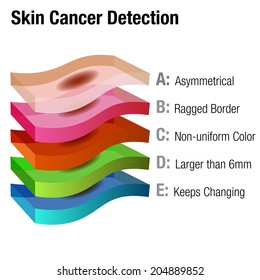 An image of a skin cancer detection chart.
