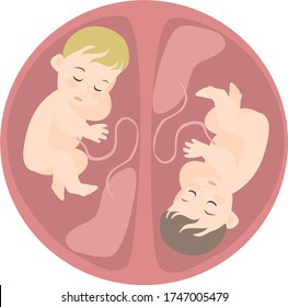 image of two different embryos in the uterine cavity with different placentas and hair color.
stock isolated illustration on white background for printing on postcards, websites, shop advertising 