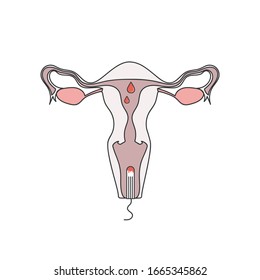Image of the use of a tampon. Online image of the inside of the uterus with a tampon on. Schematic icon