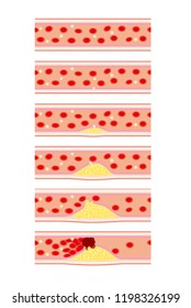 Image of vascular disease such as arteriosclerosis
