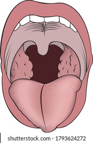 Images of adenoids-growth of lymphoid tissue of the nasopharyngeal tonsil. Image of a mouth with a protruding tongue and adenoids.
