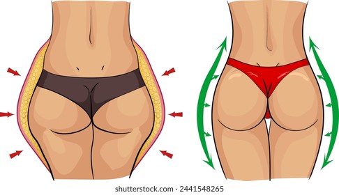 Images of a woman's body before and after cellulite removal with schematic markings in the form of red and green arrows. The problem of cellulite and stretch marks. 
