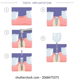 Immediate dental implantation. Modern dental implantation, step by step instructions. Vector illustration for dental textbooks