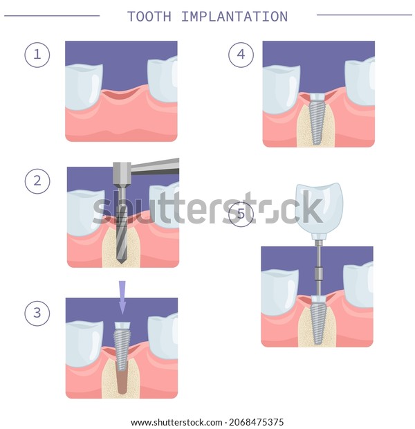 Immediate dental implantation. Modern dental\
implantation, step by step instructions. Vector illustration for\
dental textbooks