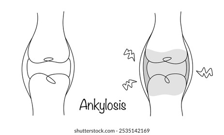 Unbeweglichkeit des Gelenks durch Knochen-, Knorpel- oder Faserverschmelzung der Gelenkenden der Gelenkknochen. Zeichnung eines gesunden Kniegelenks und eines Gelenks mit Ankylose.