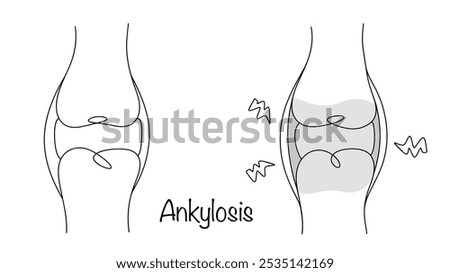 Immobility of the joint due to the formation of bone, cartilage or fibrous fusion of the articular ends of the articulating bones. Drawing of a healthy knee joint and a joint with ankylosis.