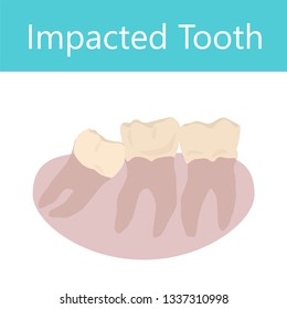 Impacked Tooth. Vector dental anatomy illustration. White background.