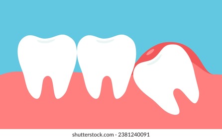 Impacted tooth inside under inflammation gum in flat design.