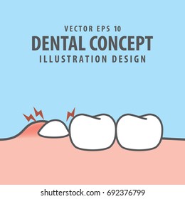 Impacted tooth inside under inflammation gum illustration vector on blue background. Dental concept.