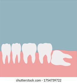 Impacted wisdom teeth. Molar tooth.