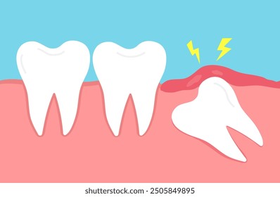 Impacted wisdom tooth. Crooked teeth. Toothache molar. inflamed and swollen gum. Dental care. Vector illustration