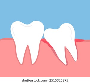 Diente del juicio impactada. Dientes torcidos. Dolor de muelas molar. Encía inflamada e hinchada. Cuidado dental. Ilustración vectorial