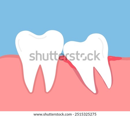Impacted wisdom tooth. Crooked teeth. Toothache molar. inflamed and swollen gum. Dental care. Vector illustration