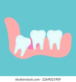 Impacted wisdom tooth. Wisdom tooth moving. Wisdom tooth under the gum. Toothache. Dental or orthodontical concept. Vector