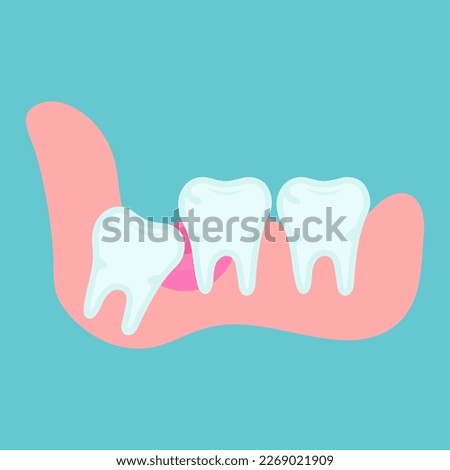 Impacted wisdom tooth. Wisdom tooth moving. Wisdom tooth under the gum. Toothache. Dental or orthodontical concept. Vector
