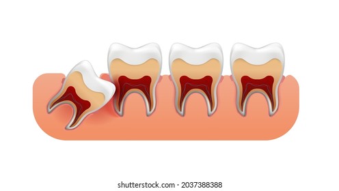 Impacted wisdom tooth. Wisdom teeth eruption problems. Inflamed gums. Vector realistic design 