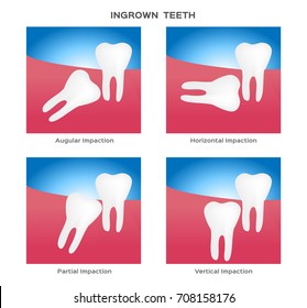 impacted and wisdom tooth vector